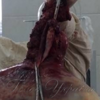 Величезна пухлина ледь умістилась у відро