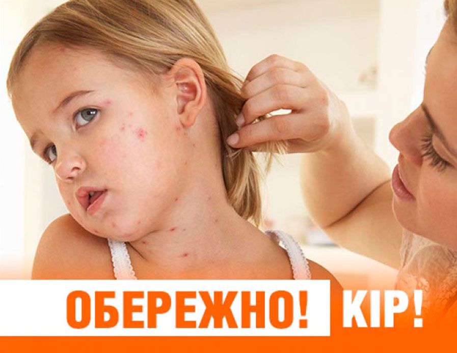 На Хмельниччині кір не здається